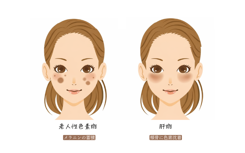 肝斑と老人性色素斑の違いを比較したイラスト(老人性色素斑はぽつんと濃く、肝斑は左右対称にもやっと広がる)