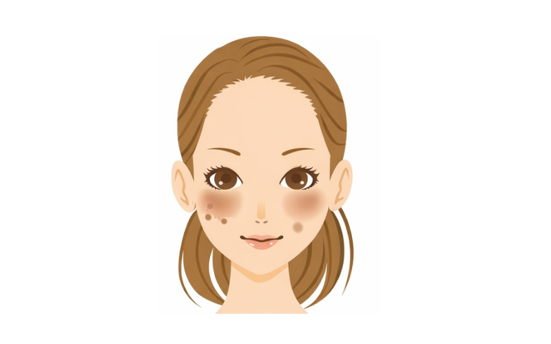 肝斑と老人性色素斑が混ざって見える例のイラスト(もやっとした肝斑の上に濃いシミが重なる)