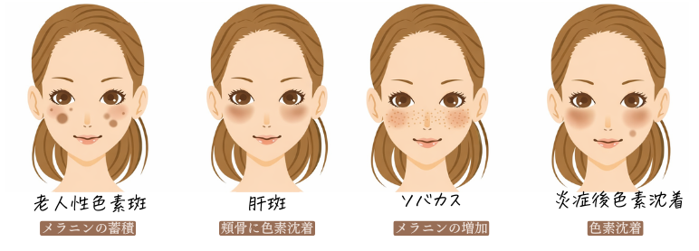 シミの種類(老人性色素斑・肝斑・そばかす・炎症後色素沈着)をまとめた図