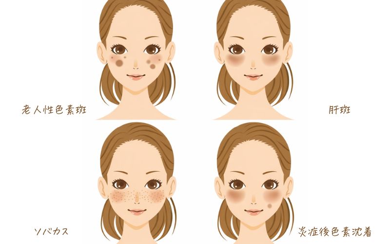 シミの4種類を説明したイラスト