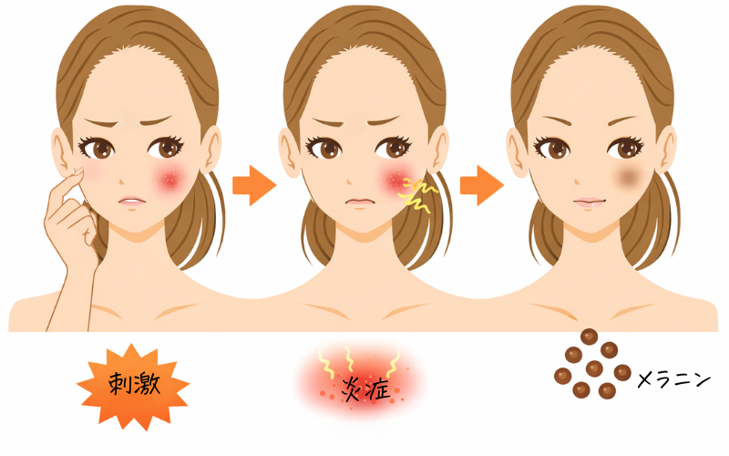 炎症後色素沈着ができる過程を示したイラスト